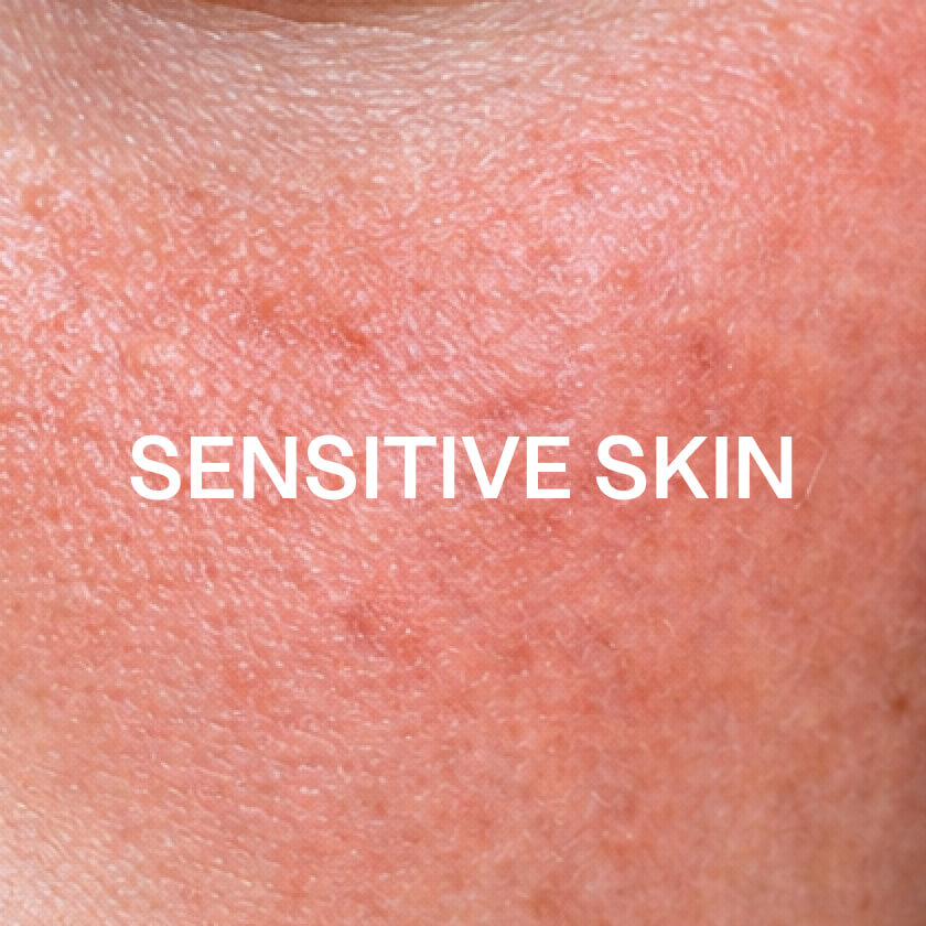 Gevoelige huid